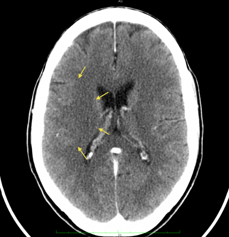 Brain Tumors - German New Medicine Practitioner